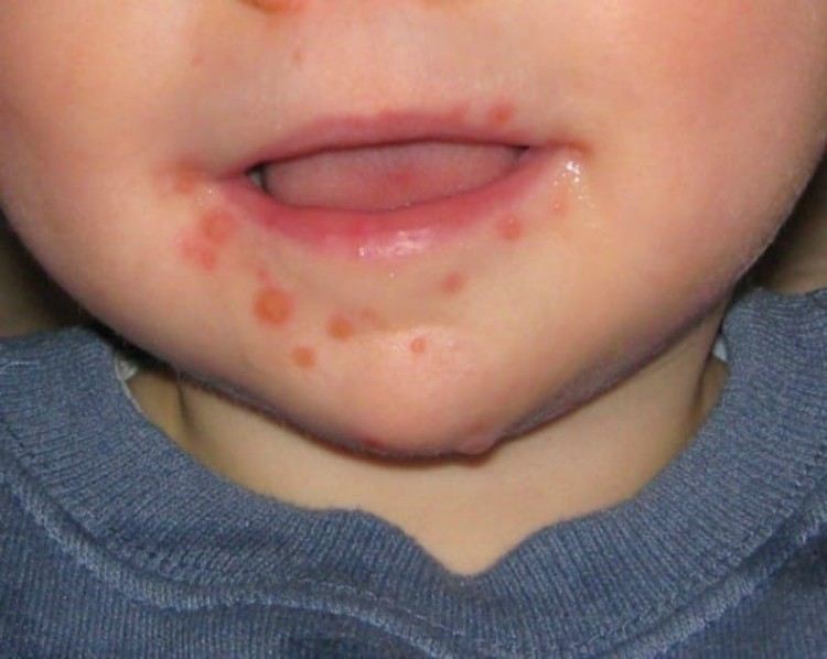 Child's mouth infected with HFMD.
