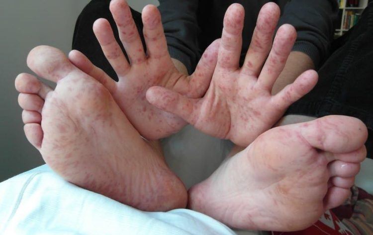 Hands and feet infected with HFMD.