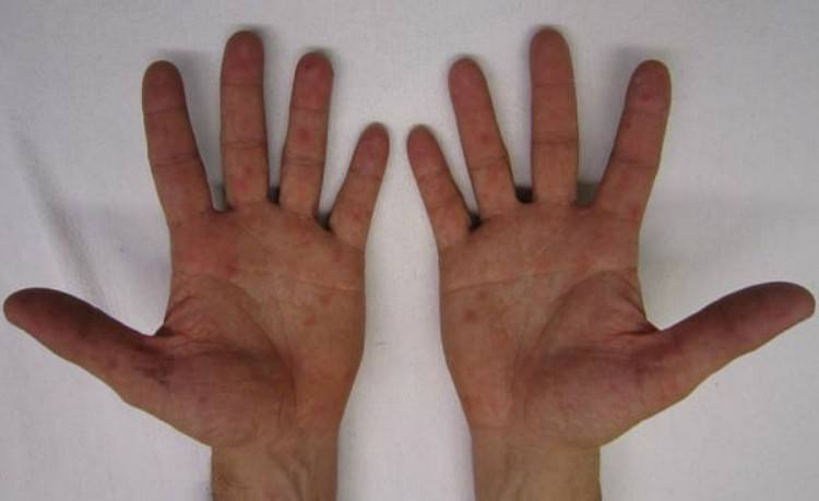 Two hands infected with HFMD