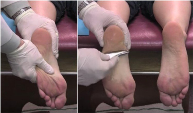 doctor using stainless steel tool for plantar fasciitis treatment