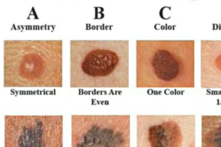 Image result for skin cancer