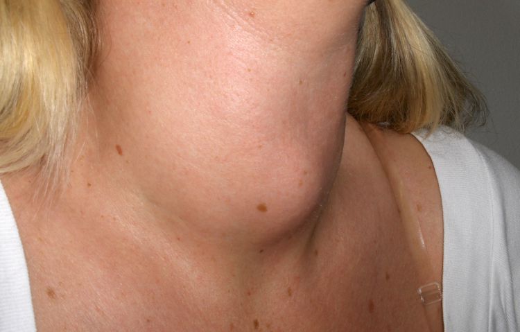 Image of a goiter.